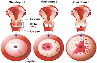 Làm thế nào để nhận biết ung thư cổ tử cung?