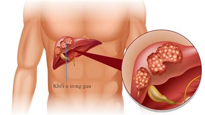 Bệnh ung thư gan là gì, ung thư gan nguy hiểm thế nào và phương pháp điều trị cho bệnh ung thư gan