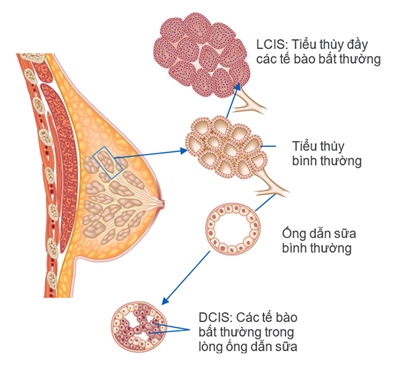 Ung thư vú là gì, dấu hiệu và triệu trứng thường gặp của bệnh ung thư vú?