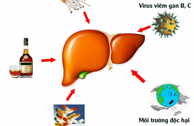 Nguyên nhân gây ung thư gan