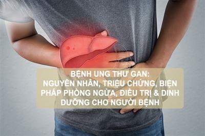 Bệnh ung thư gan, nguyên nhân gây ung thư, triệu chứng và phương pháp điều trị ung thư gan